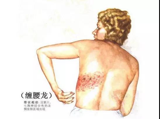 【祖傳秘方】程式中醫(yī)教你(nǐ)如(rú)何對(duì)陣帶狀疱疹